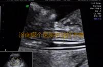 济南哪个医院供卵好济南市中心医院试管婴儿技术怎么样‘b超看男女双顶径’
